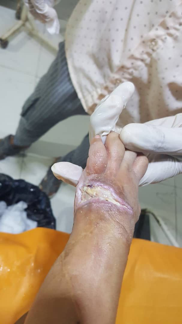 Helping a child treat his hand / Yemen 🙋🏻‍♂️